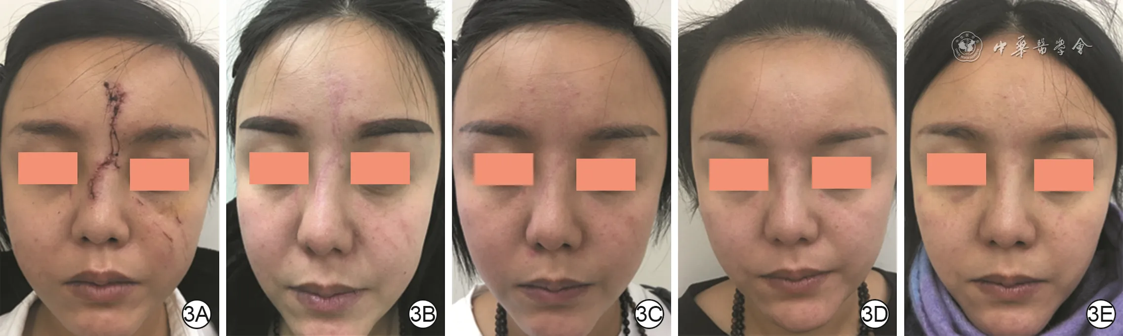 Serial follow-up of early adult forehead, nasal, and facial wounds during long-term multimodal tissue remodeling with oral medication, local injection, ion-beam treatment, and fractional carbon dioxide laser