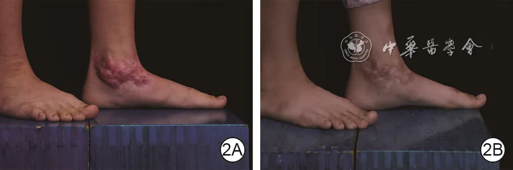 Left ankle hypertrophic scar before and nine months after pressure therapy combined with narrow-band intense pulsed light
