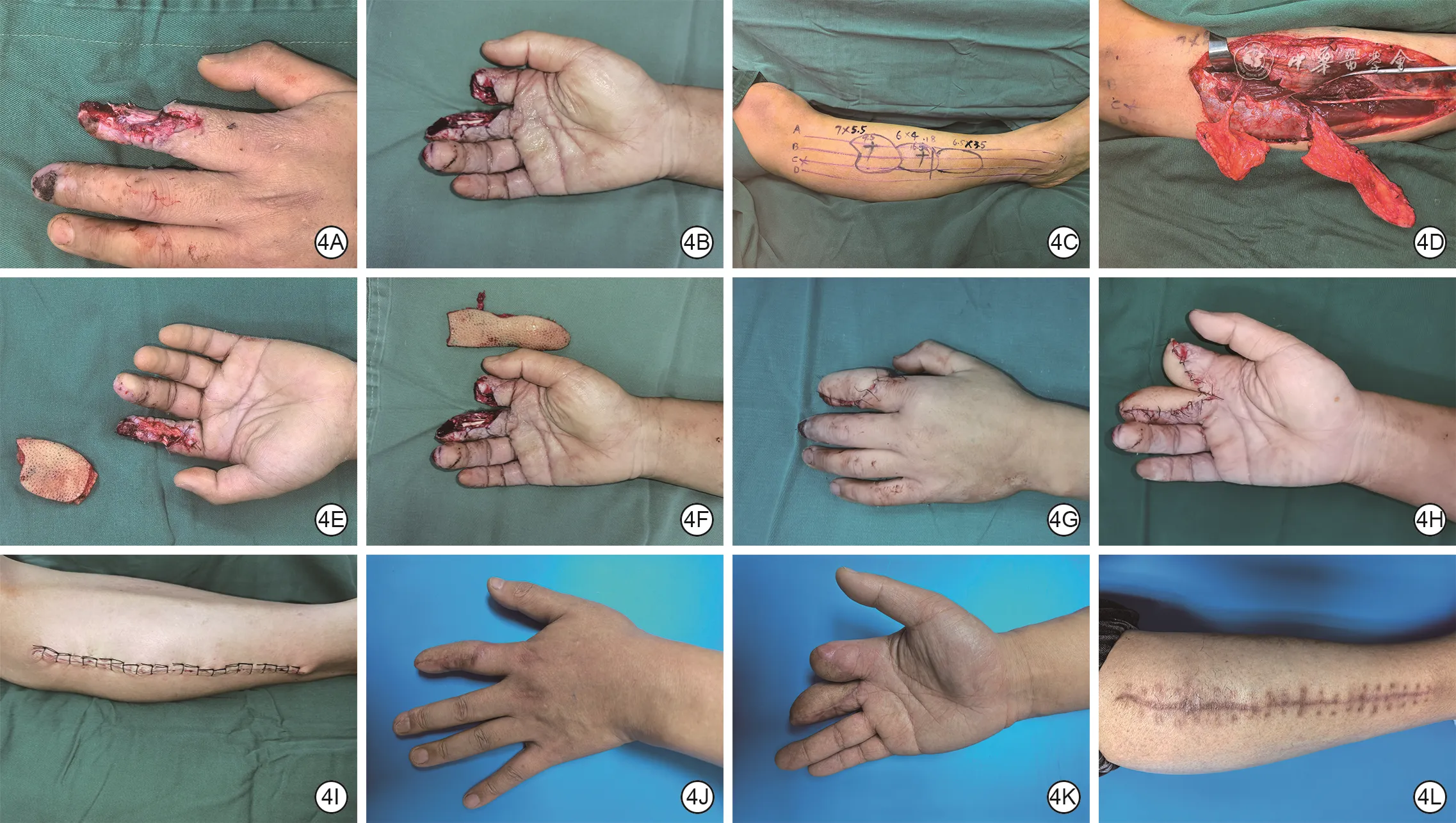 Operative sequence and eight-month follow-up of bilateral hand reconstruction with anterior tibial and superficial peroneal artery perforator flaps designed using the three-source and four-line method