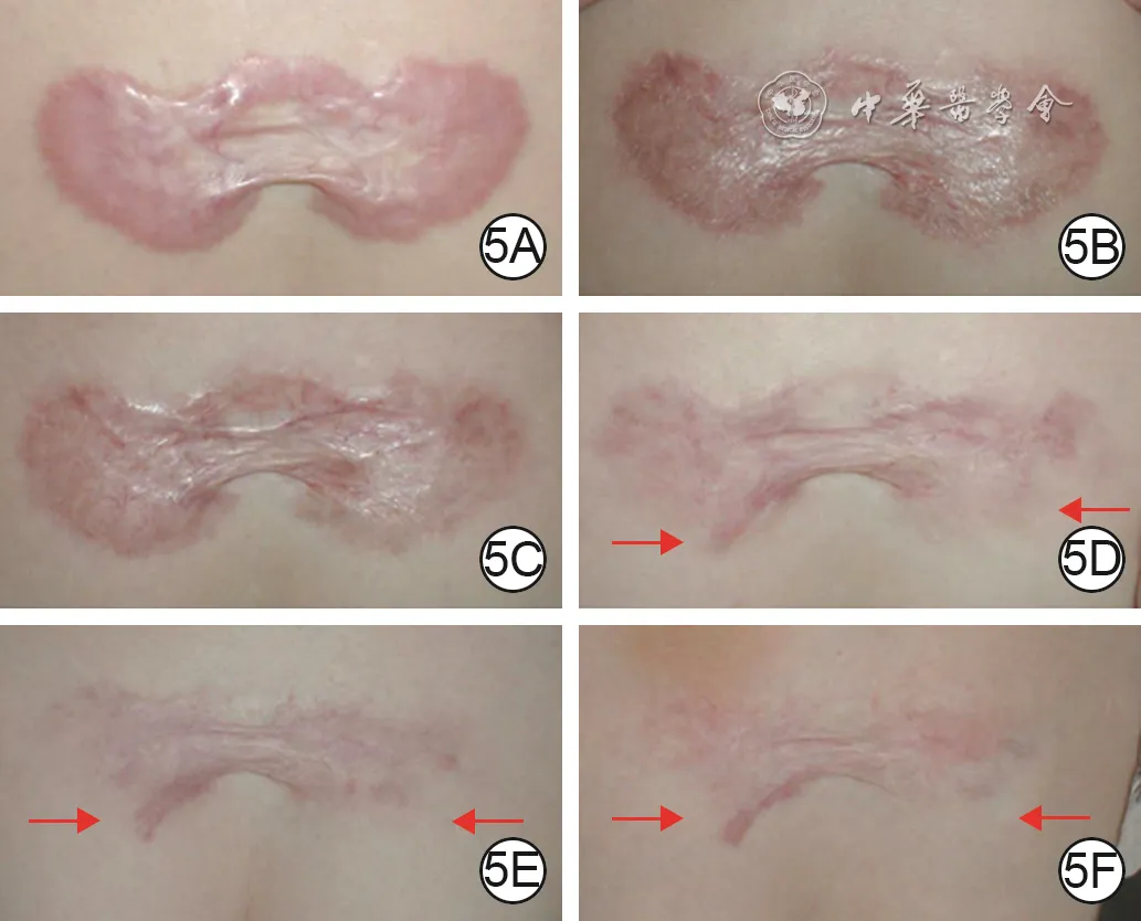 Long-term follow-up of a plaque-like chest keloid treated with alternating low-concentration 5-fluorouracil and triamcinolone injections with dynamic adjustment of concentration and interval