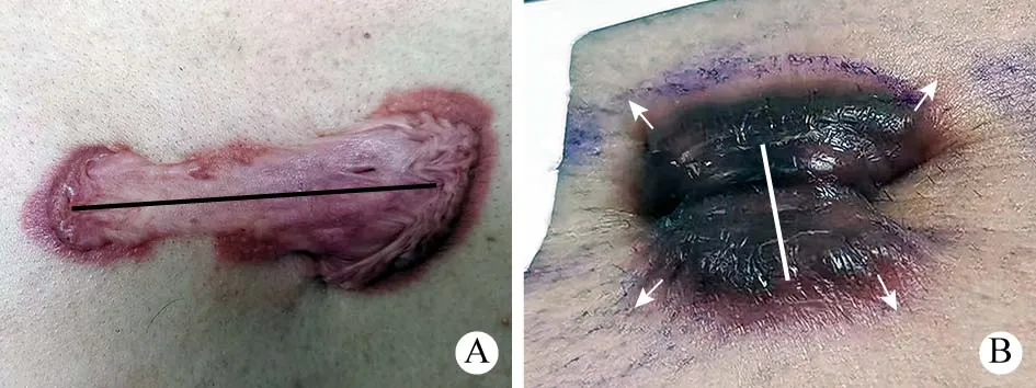 Linear incision planning for manubrial and xiphoid chest-wall keloids according to the lesion axis and surrounding skin-tension direction