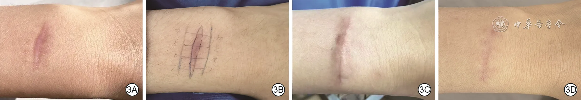 Forearm hypertrophic scar before, during, one month after, and twelve months after fusiform excision with local tension-reducing closure
