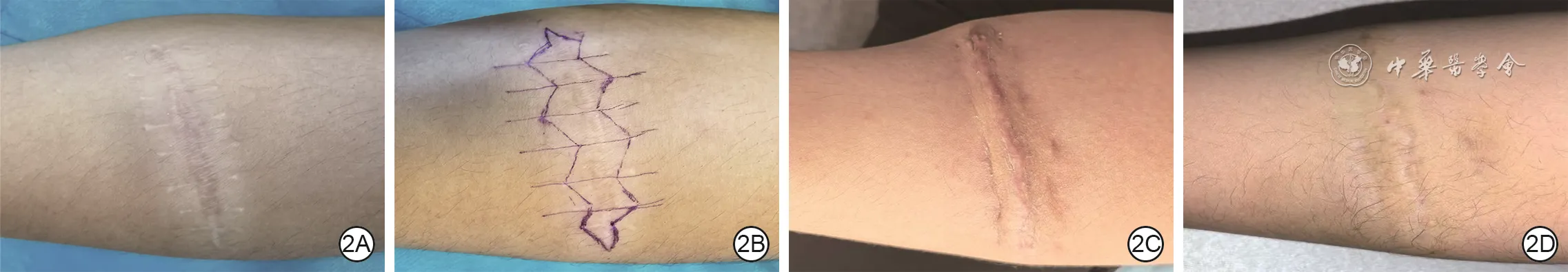 Right forearm scar before, during, one month after, and twelve months after W-plasty excision with remote tension-reducing sutures