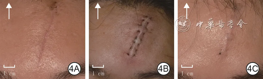Forehead linear surgical-incision scar before horizontal buried intradermal suturing combined with fractional carbon dioxide laser, immediately after suturing, and one month after combined treatment