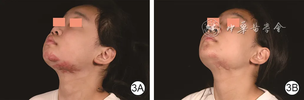 Mandibular hypertrophic scar before and nine months after pressure therapy combined with narrow-band intense pulsed light