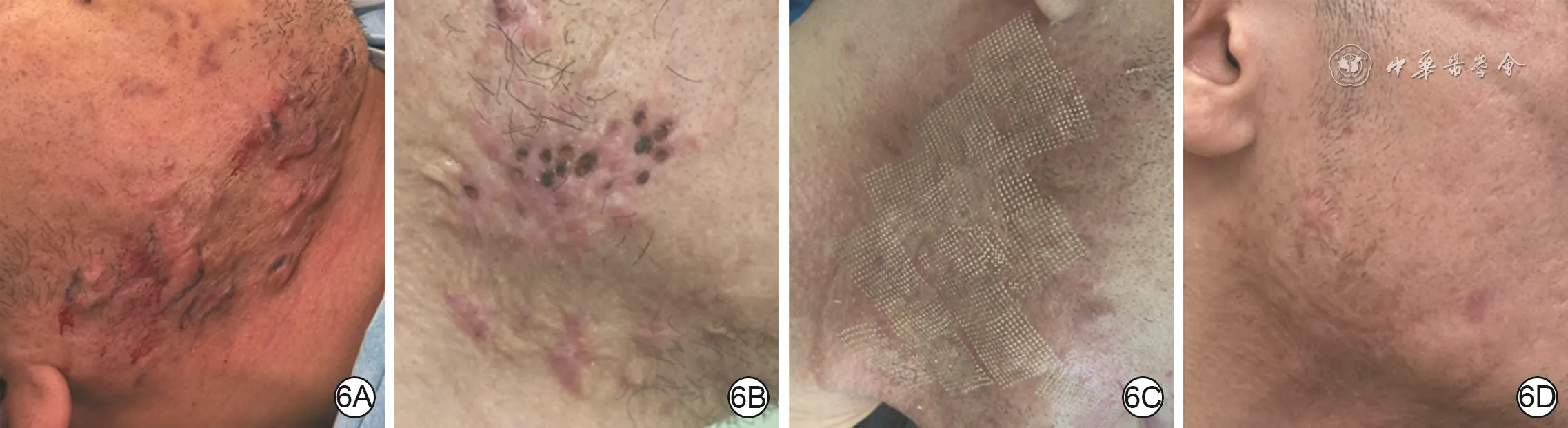 Serial follow-up of multiple scattered right mandibular keloids treated with two punch excisions followed by fractional carbon dioxide laser remodeling