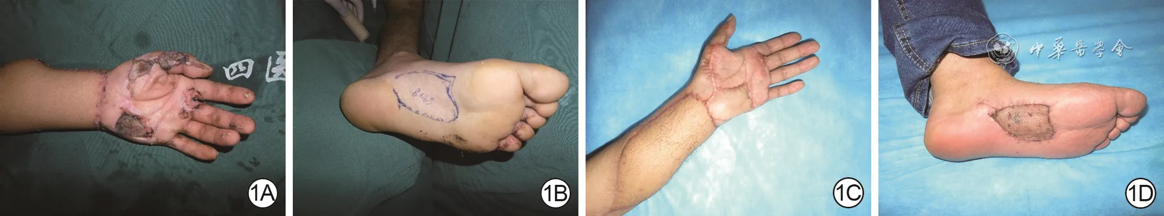 Preoperative, intraoperative planning, and six-month follow-up images of a left palmar electrical burn reconstructed with a left medial plantar free flap