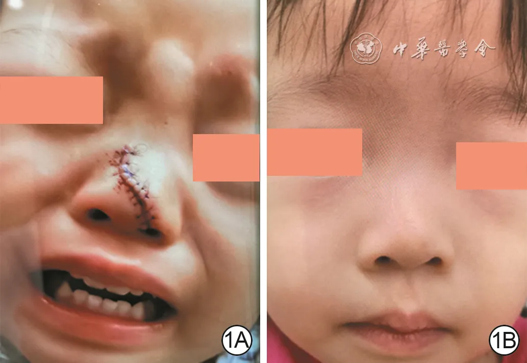 Pediatric nasal glass laceration after suturing, before and after early scar intervention with fractional carbon dioxide laser and needle-knife release of subcutaneous adhesion