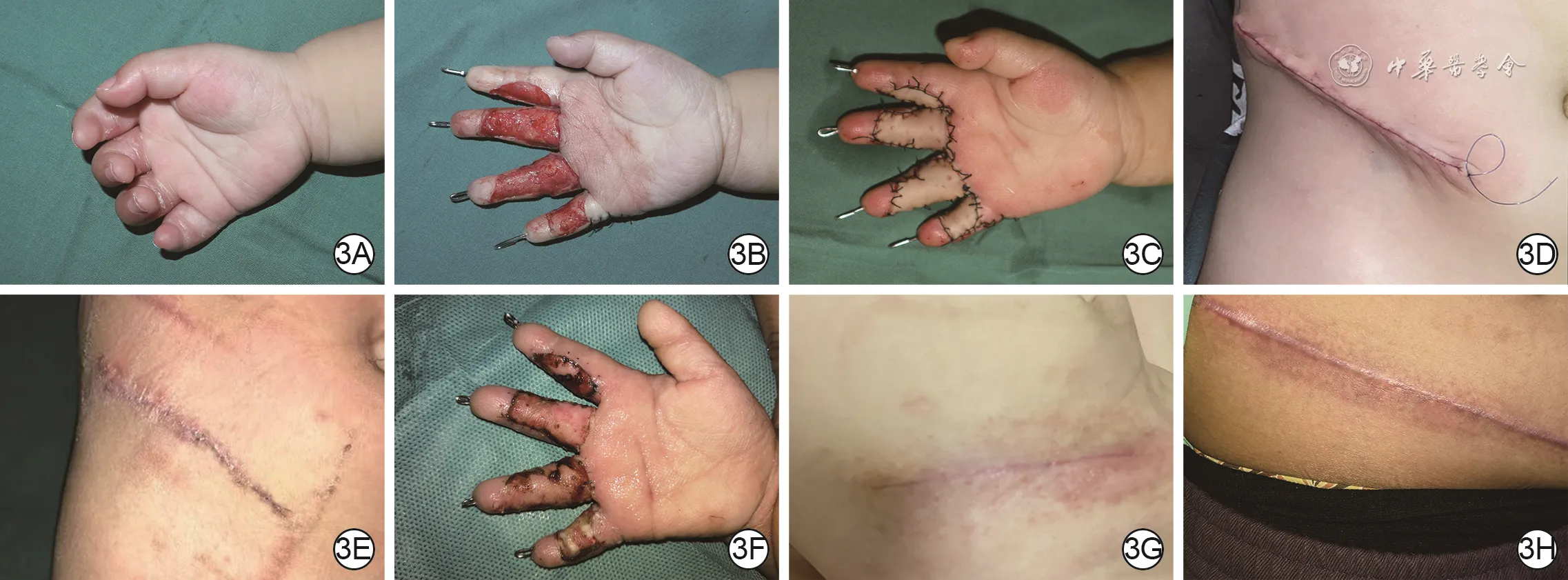 Preoperative, operative, and donor-site follow-up images of a pediatric right palmar scar contracture repaired with a full-thickness skin graft from the lateral abdomen