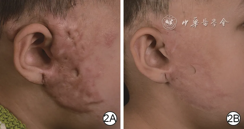 Early red hypertrophic scar in the right preauricular region of a child before and after combined laser treatment with multipoint microinjection of triamcinolone