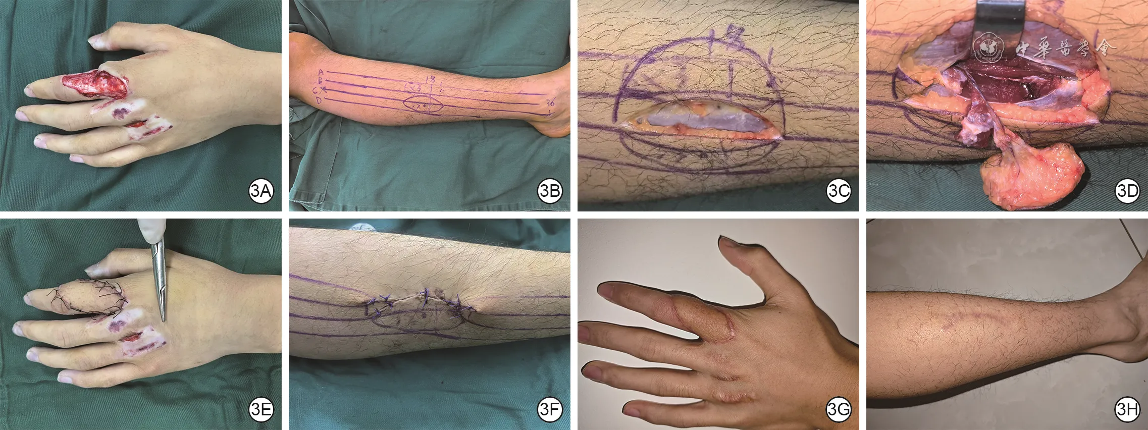 Operative sequence and ten-month follow-up of left-hand reconstruction with a superficial peroneal artery perforator flap designed using the three-source and four-line method