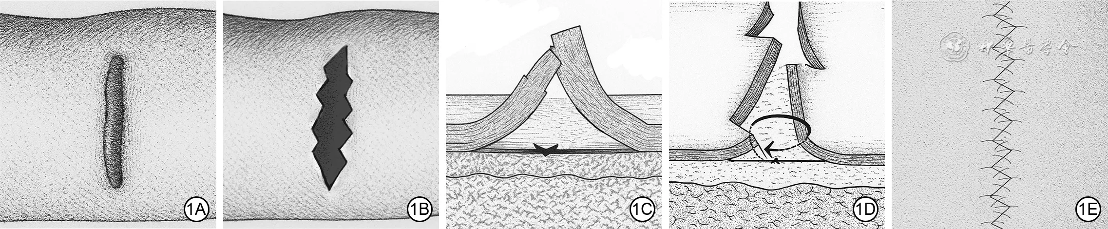 Five-panel illustration of W-plasty excision combined with remote tension-reducing sutures